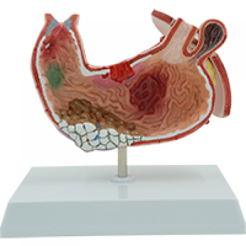 病理胃（帶橫（héng）隔）模（mó）型