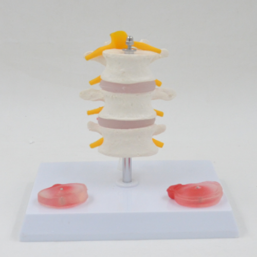 3節腰椎帶2個病（bìng）變（biàn）椎間盤模型