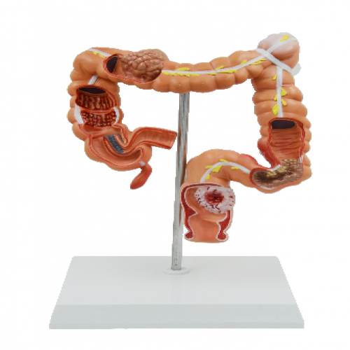 結腸（cháng）病理模型